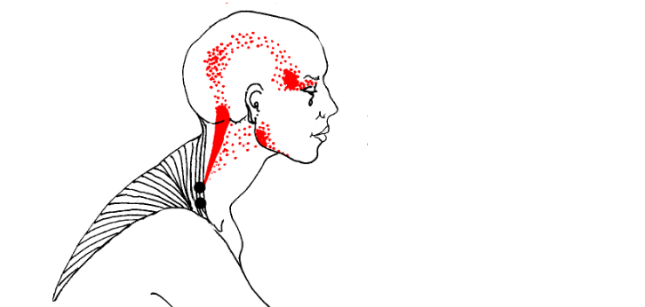 ram's horn headache