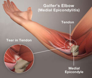 How Can Physical Therapy Help My Golfer's Elbow (Medial Epicondylitis ...