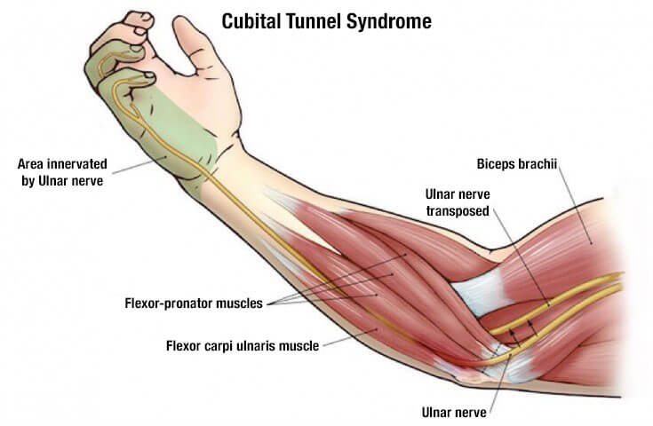Treating Cubital Tunnel Syndrome, Cubital Tunnel Syndrome, Elbow and more