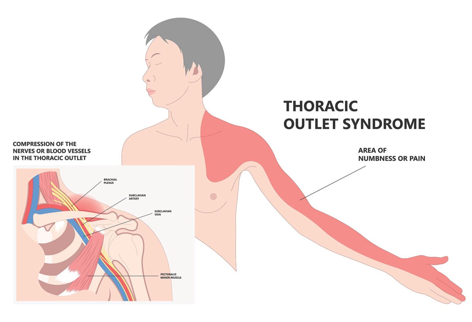 Understanding Thoracic Outlet Syndrome: Causes, Symptoms, and Treatment ...