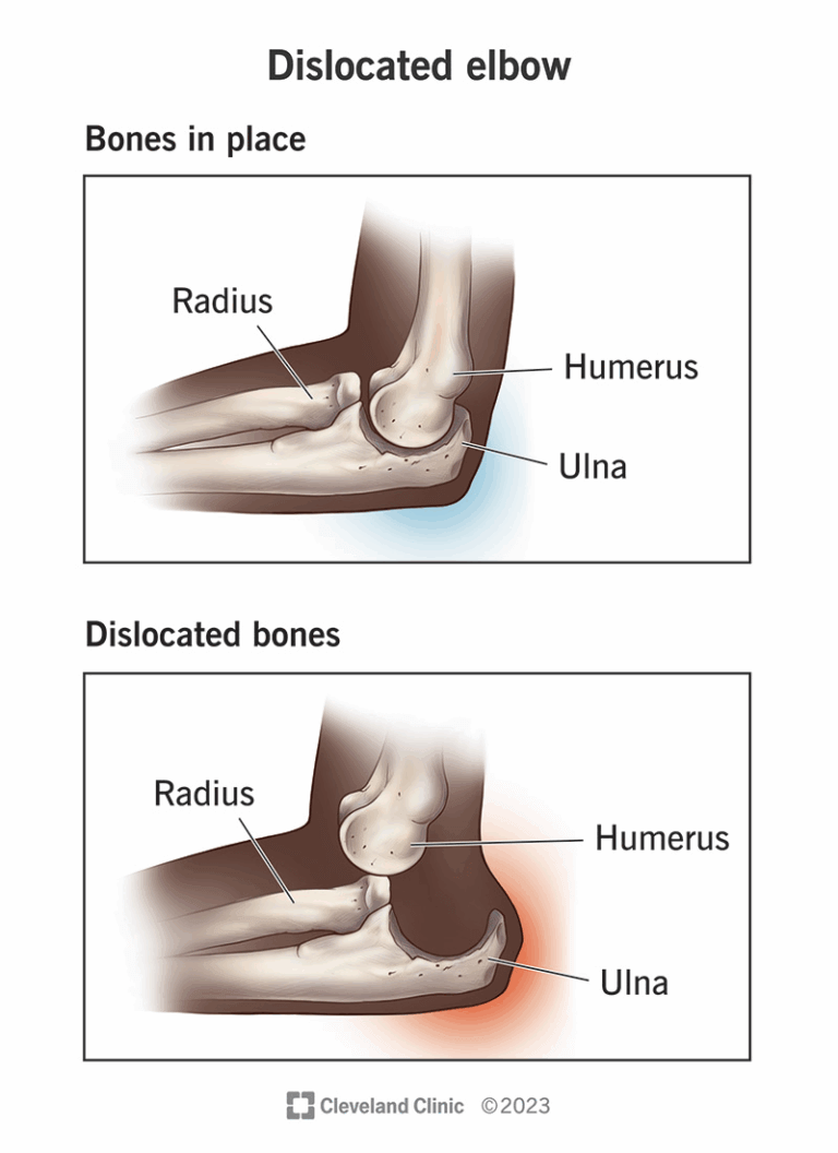 Displaced Elbow Understanding the Elbow Joint: Anatomy, Dislocations, and Common Elbow ...