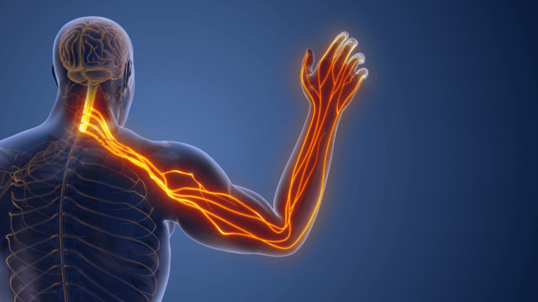 What Is Cervical Radiculopathy? Causes of Neck Pain Radiating to the ...